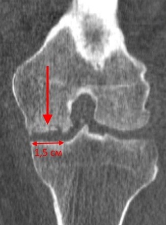 Ррассекающій остеохондрит колінного суглоба, хвороба Кеніга колінного суглоба лікування, розтинає