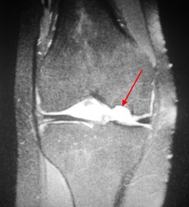 Rassekayuschy osteochondrită a articulației genunchiului, genunchi genunchi tratament boală, disecție