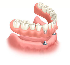 Знімні зубні протези плюси і мінуси знімних зубних протезів