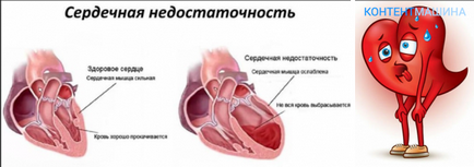 Серцева недостатність 1 та 2 ступеня симптоми і лікування
