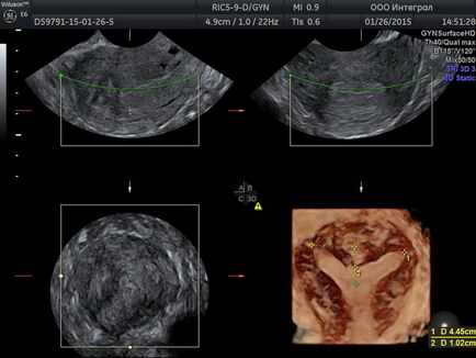 Uterul cervical atunci când sarcina este norma de lungime de săptămâni, de ce scurt