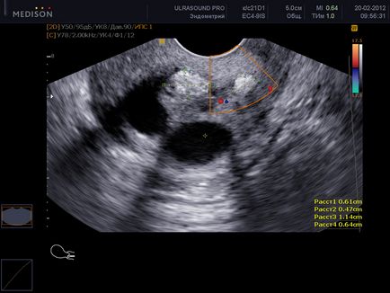 Uterul cervical atunci când sarcina este norma de lungime de săptămâni, de ce scurt