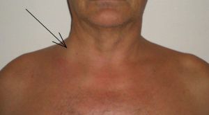 Симптоми і лікування тромбозу глибоких вен плеча (синдром Педжета Шреттера)