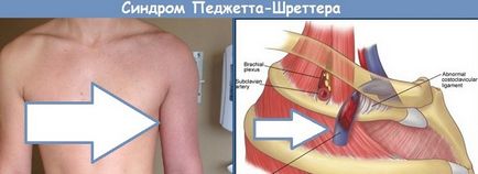 Simptomele și tratamentul trombozei venoase profunde a umărului (sindromul sindromului Paget)