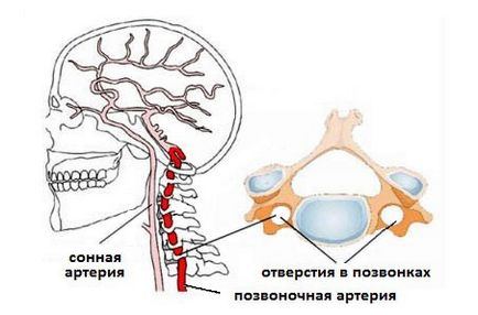 Sindromul arterei vertebrale cu osteocondroză cervicală, tratament, simptome