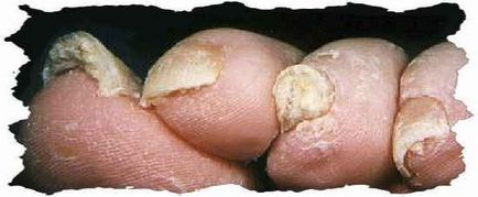 Amenințarea ascunsă este să înveți adevărul teribil despre ciupercă, până când îți taie unghiile!