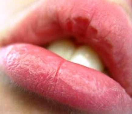Сухість, свербіж, лущення і печіння губ кращі рецепти для лікування
