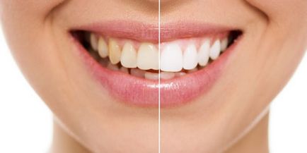 Top 5 metode de albire a dinților la domiciliu