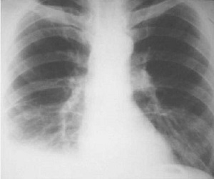 Tuberculoza ganglionilor limfatici intrathoracici la copiii cu complicații ale bolii