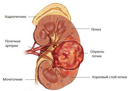 Eliminarea unei tumori (cancer) a rinichiului