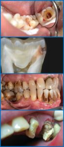 Видалення пульпи зуба лікування пульпіту