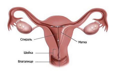 Descărcarea după instalarea spiralei intrauterine sângeroase, maro, sub formă de mucus