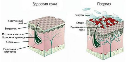 Tipuri și forme de psoriazis - clasificare pe tipuri