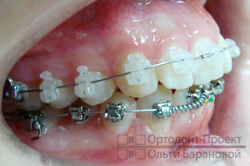Вирівнювання зубів за допомогою брекетів damon