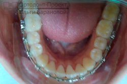 Вирівнювання зубів за допомогою брекетів damon