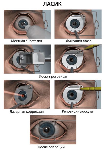 Відновлення зору після лазерної корекції очей основні правила