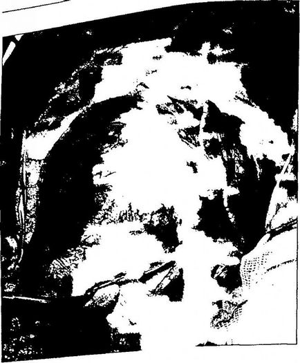 Sebészet aneurizma a felszálló aorta aorta elégtelenség annulo (tachycardia) Sebészet aneurizma a felszálló aorta aorta elégtelenség annulo
