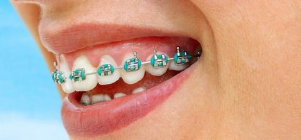 Cronicile unui purtător de bretele despre alegerea ortodonției, a bretelelor și a instalării acestora