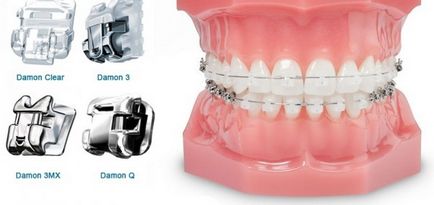 Cronicile unui purtător de bretele despre alegerea ortodonției, a bretelelor și a instalării acestora