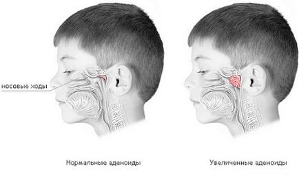 Закладений ніс але нежиті немає способи відновлення дихання