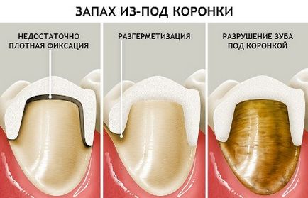 Запах з під коронки зуба що робити, як усунути