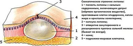 Wen hogyan megszüntetésére otthon, ha el kell távolítani a lipoma