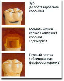 зубне протезування