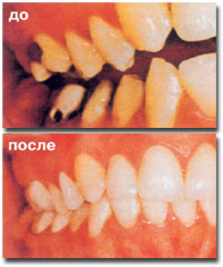 Proteză dentară