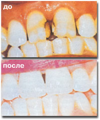 зубне протезування