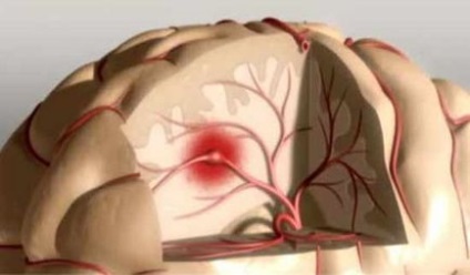 Afazia după un accident vascular cerebral determină apariția, forma și manifestarea