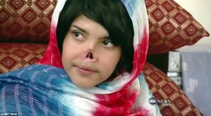 Афганської дівчини, якій чоловік відрізав ніс, зробили нове обличчя
