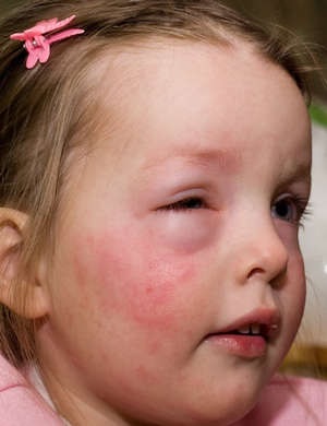 Erupții alergice pe fața și corpul copiilor de vârste diferite