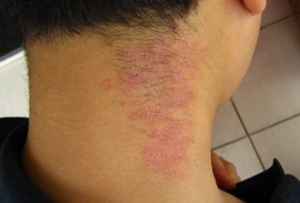 Allergiás a bőrt, és annak okait annak előfordulása