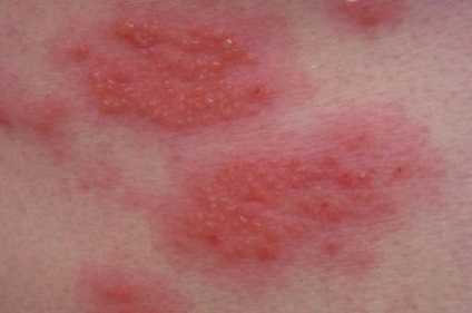 Allergiás a bőrt, és annak okait megjelenését (bőr) Allergiás a bőrt, és annak okait annak előfordulása