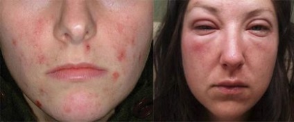 Алергія на обличчі у немовляти і дорослого причини, симптоми, лікування
