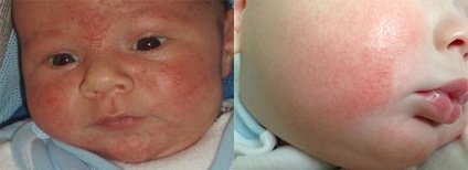 Alergia pe fața copilului și cauzele adulților, simptome, tratament