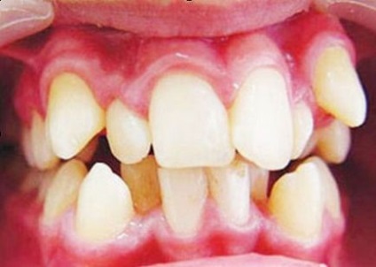 Anomalii ale tratamentului de poziționare a dinților, simptome, etiologie