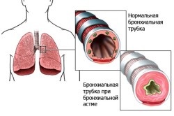 Astm la copiii cu simptome și tratament