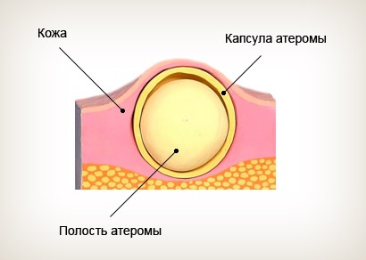 Atheroma Simptomele și tratamentul