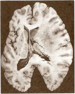 Angioencefalopatia aterosklerotică în sistemul arterei carotide interne - patologia capului