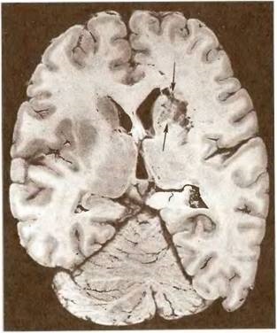 Angioencefalopatia aterosklerotică în sistemul arterei carotide interne - patologia capului