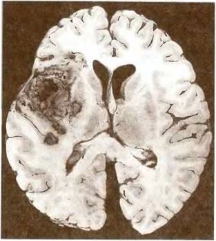Angioencefalopatia aterosklerotică în sistemul arterei carotide interne - patologia capului