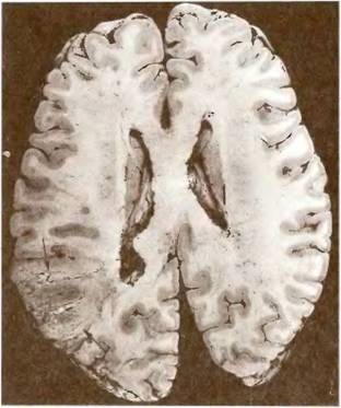 Angioencefalopatia aterosklerotică în sistemul arterei carotide interne - patologia capului