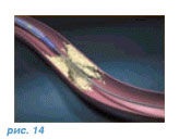 Balon, angioplastie coronariană, stenting coronarian al vaselor