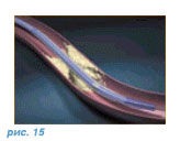 Balon, angioplastie coronariană, stenting coronarian al vaselor