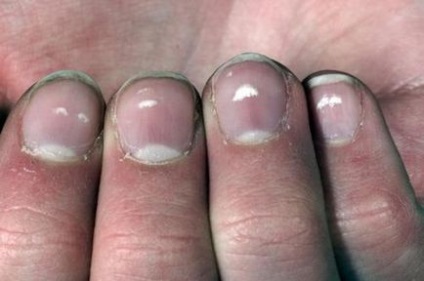 Білі плями на нігтях причини появи на пальцях рук
