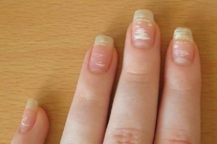 Білі плями на нігтях причини появи на пальцях рук