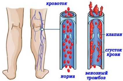 Чим небезпечний тромбофлебіт небезпека тромбозу глибоких вен нижніх конечночтей, лікування варикозу