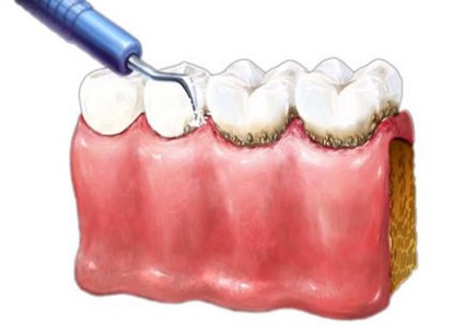 Чищення зубів у стоматолога як її роблять