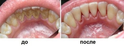 Чищення зубів у стоматолога як її роблять